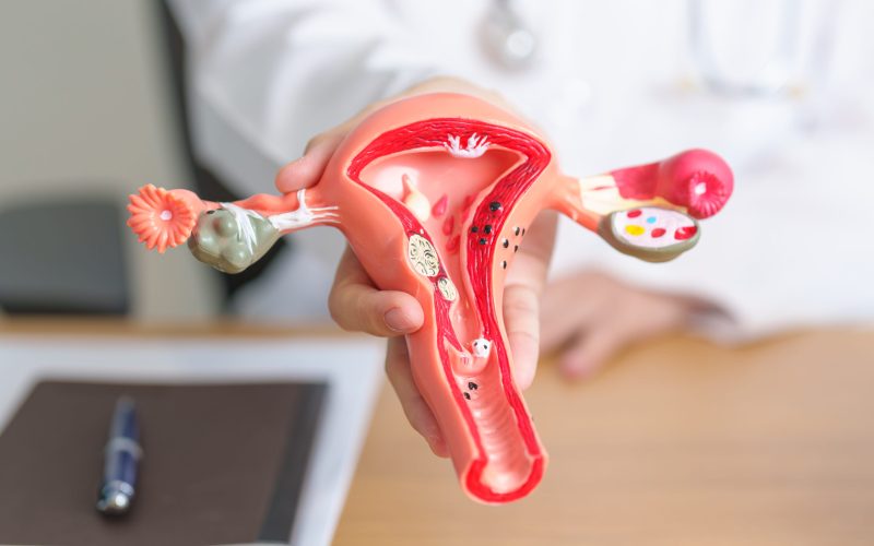 Doctor with Uterus and Ovaries anatomy model. Ovarian and Cervical cancer, Cervix disorder, Endometriosis, Hysterectomy, Uterine fibroids, Reproductive system, Pregnancy and health concept